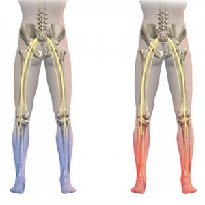 Knee Pain due to Spinal Misalignment